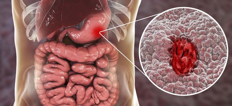 Hemorragia digestiva alta en los adultos: evaluación y gestión