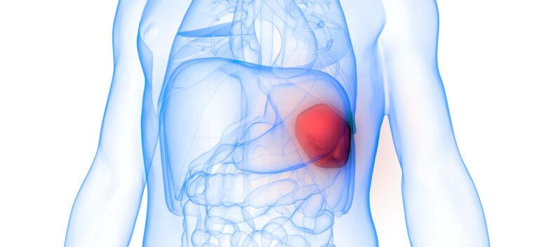 Esplenomegalia (agradamiento del bazo): Diagnóstico y tratamiento en adultos