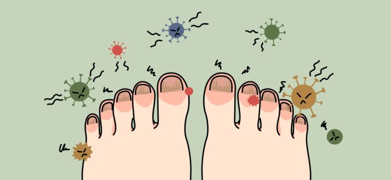 Onychomycosis: Rapid Evidence Review