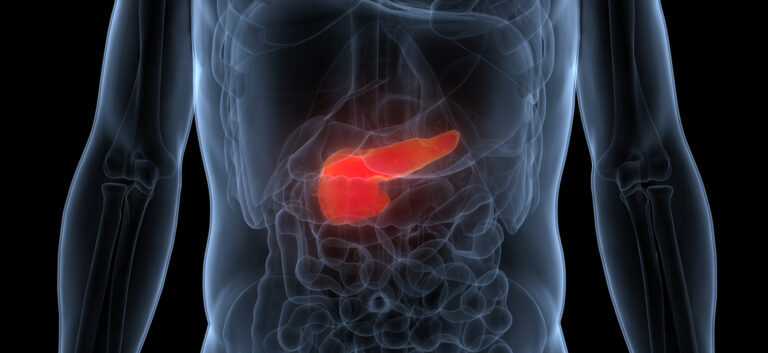 Acute Pancreatitis: Rapid Evidence Review