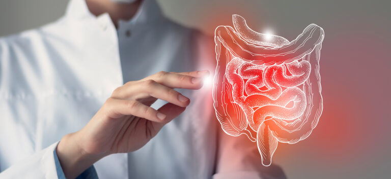 Colite ulcerosa: revisione rapida delle evidenze
