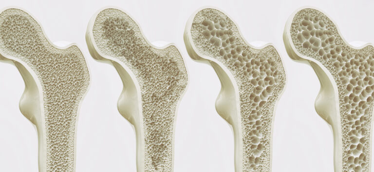 Osteoporosi: domande e risposte