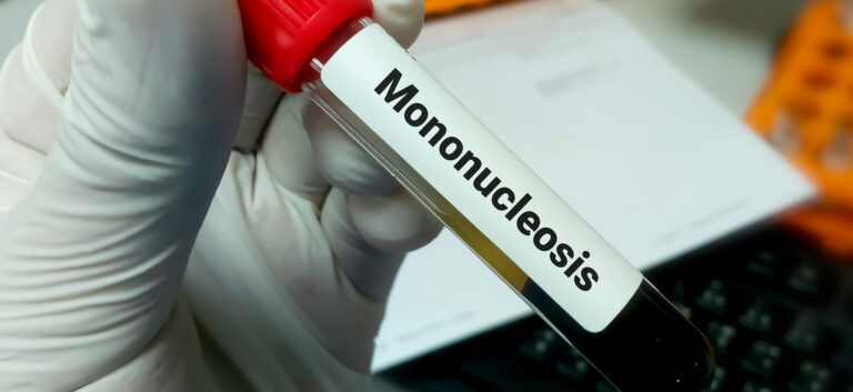 Infectious Mononucleosis: Rapid Evidence Review