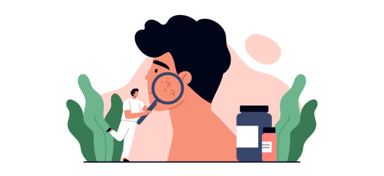 Rosacea: risposte alle domande più comuni