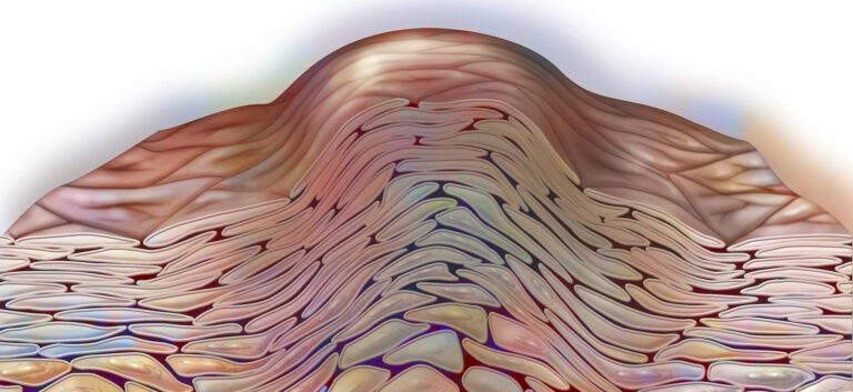 Protetto: Diagnosi dei comuni tumori cutanei benigni