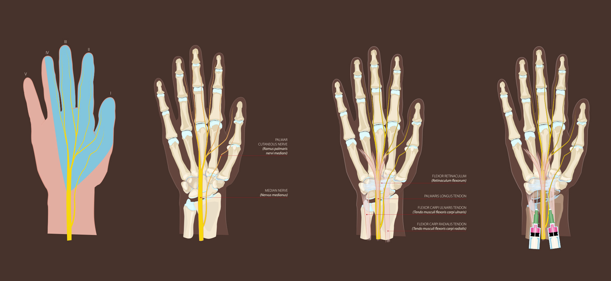 Infiltrazioni della mano e polso: Parte II. Sindrome del tunnel carpale, cisti gangliari, sindrome da intersezione, lesione del complesso fibrocartilagineo triangolare e tenosinovite di De Quervain