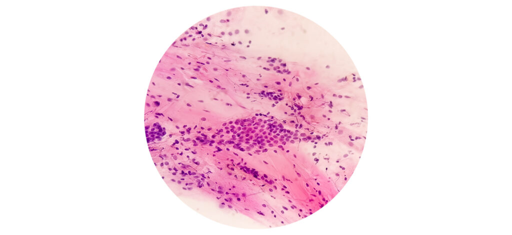 Cervical Cancer Screening