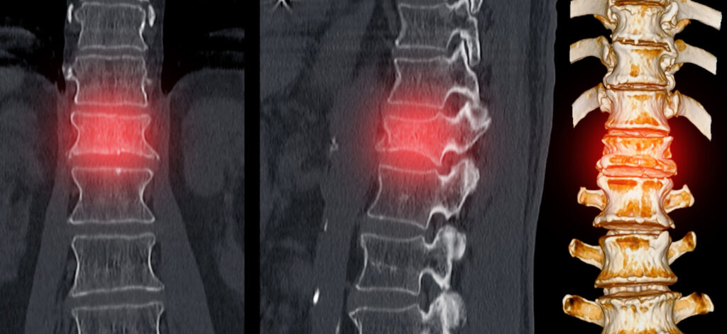 Vertebral Compression Fractures