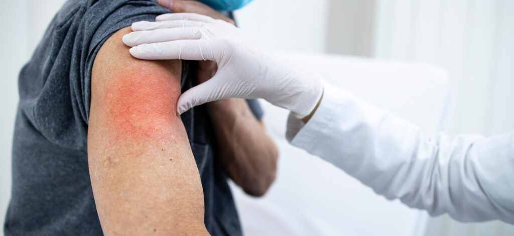 Vaccine Adverse Effects: An Overview